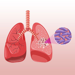 Tuberculosis treatment